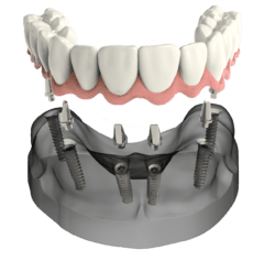 implant secured denture allentown pa