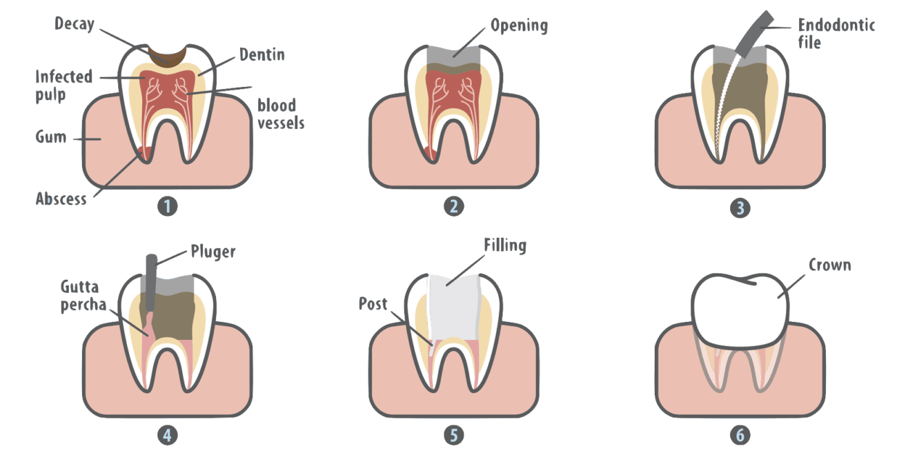 root canal procedure allentown pa endodontist 