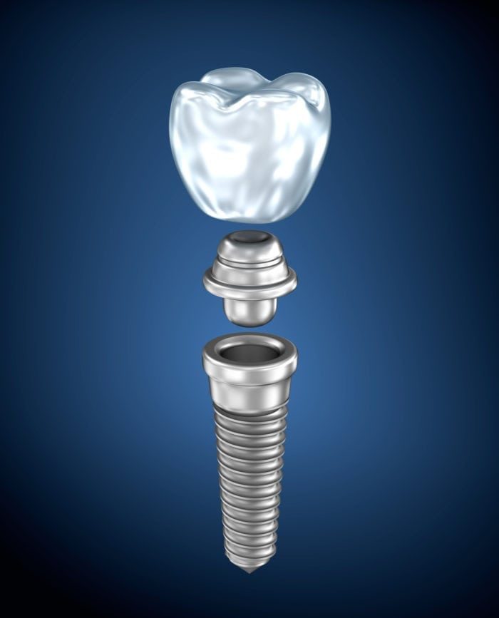 Dental Implants Allentown, PA for missing teeth