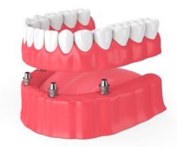 Dental Implant Allentown PA