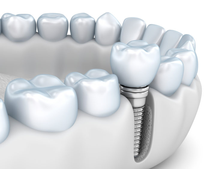 Dental implant for single tooth replacement