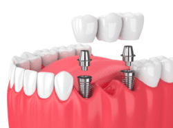 Dental Implant Allentown PA