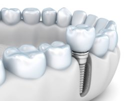 dental implants in allentown, pa