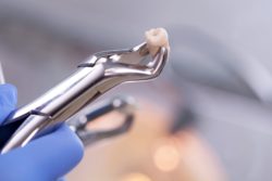 tooth extraction at allentown, pennsylvania dentist
