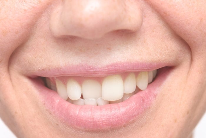 Treat Crooked Teeth in Allentown, Pennsylvania