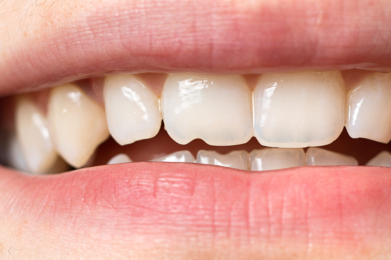 Treating Tooth Damage in Allentown, PA