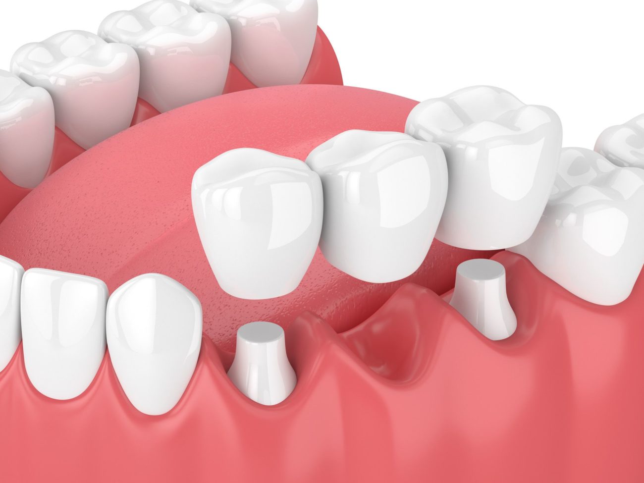 3d image of jaw with dental bridge benefits of dental bridges restorative dentistry dentist in Allentown Pennsylvania
