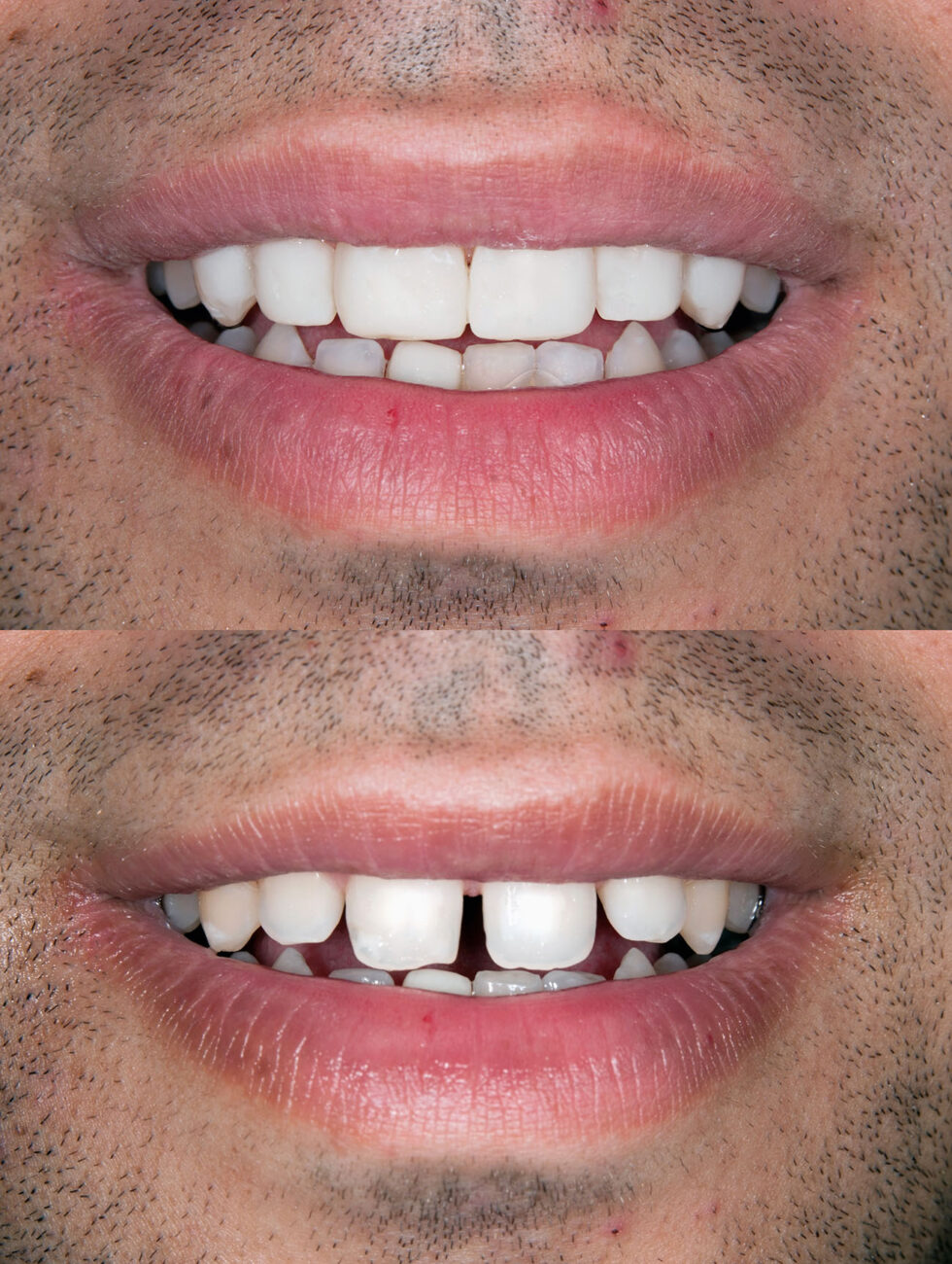 Smile with gaps in the teeth before and after cosmetic treatment dentist in Allentown Pennsylvania