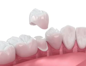 Can a Dental Crown Save Your Tooth? in Allentown, PA