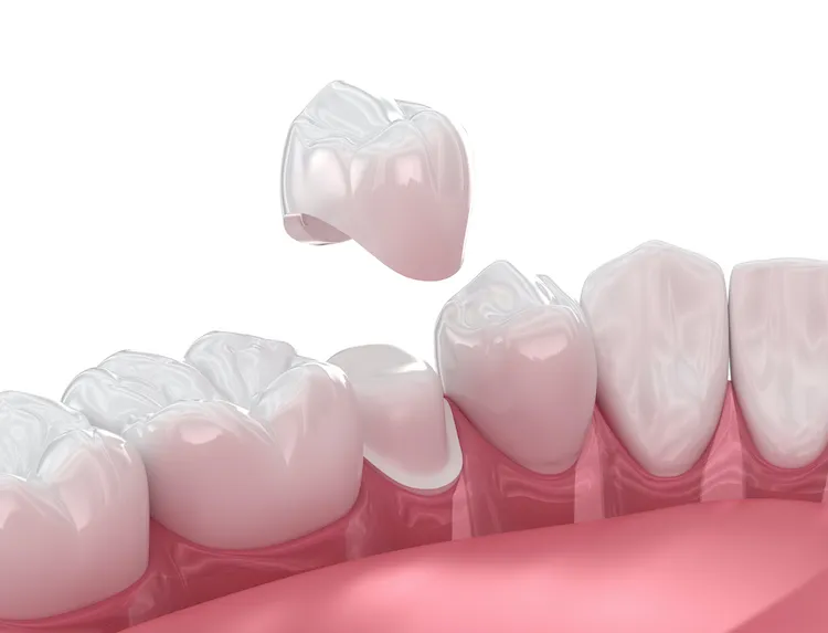 Can a Dental Crown Save Your Tooth? in Allentown, PA